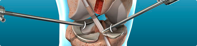 Reconstrução Ligamentar